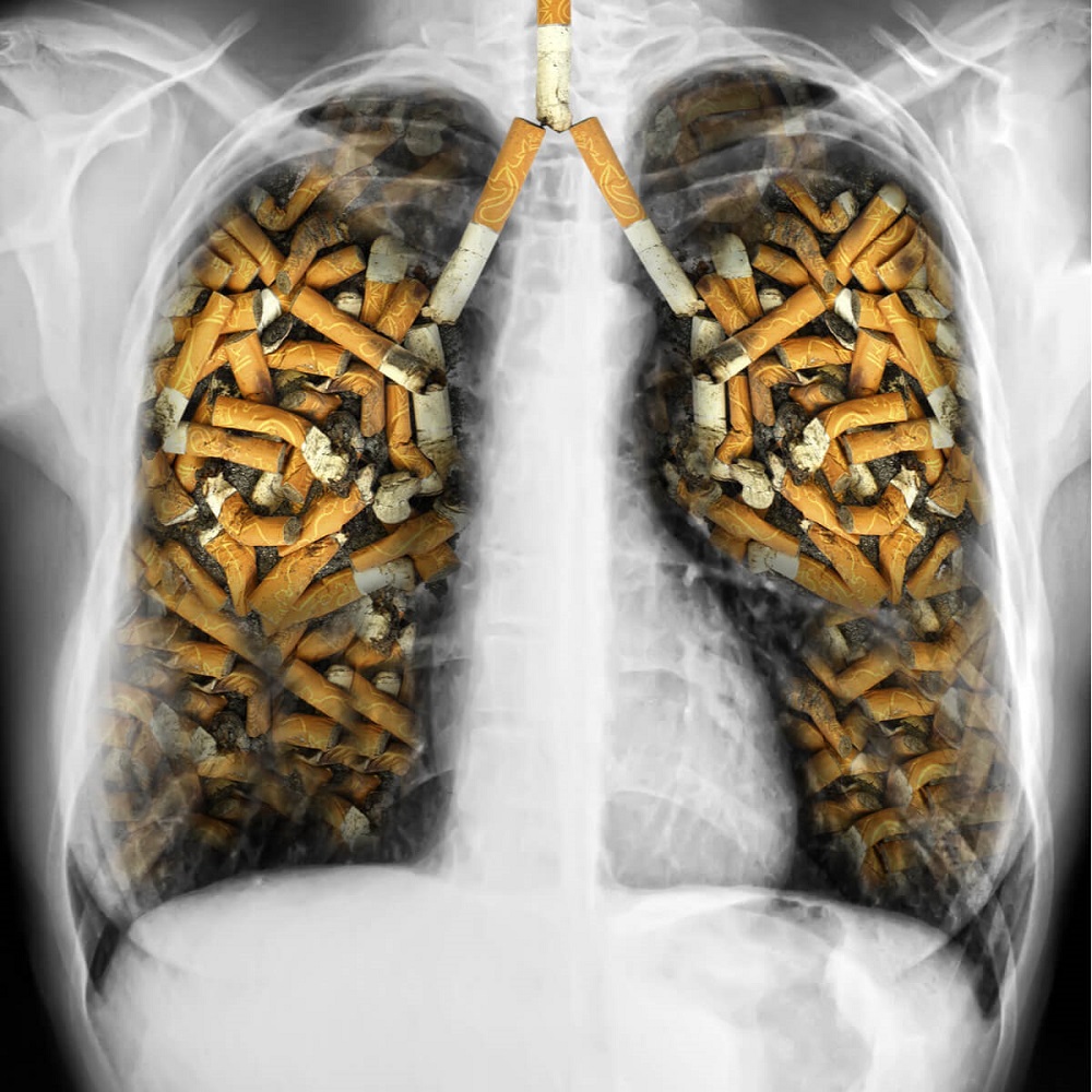 pušačka pluća, covid i duvan povećavaju rizik od pogoršanja stanja