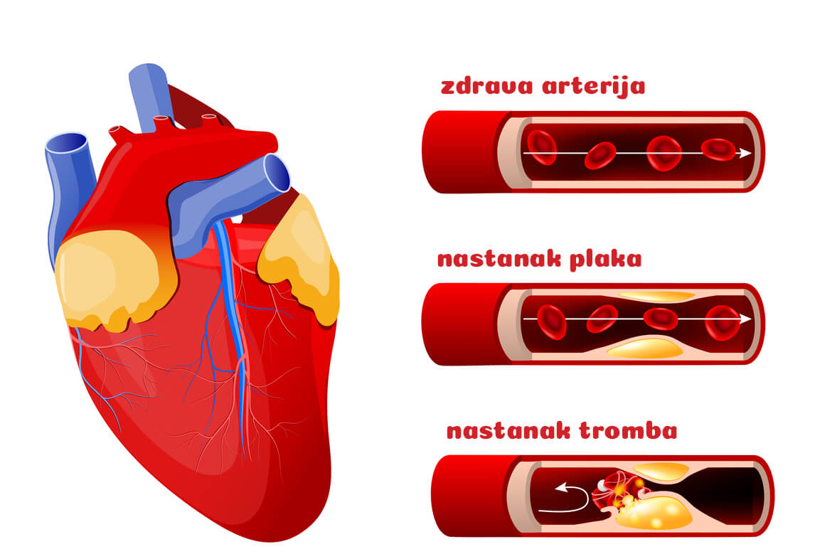 Ilustracija zdrave arterije, nastanka plaka i tromba