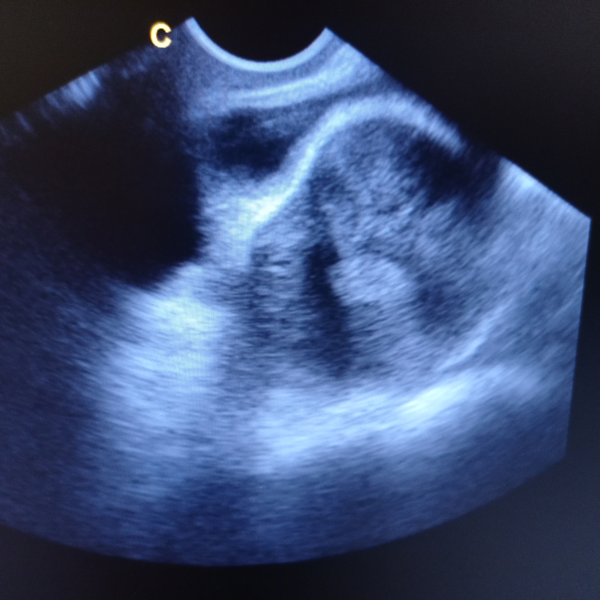 miomi na ultrazvuku