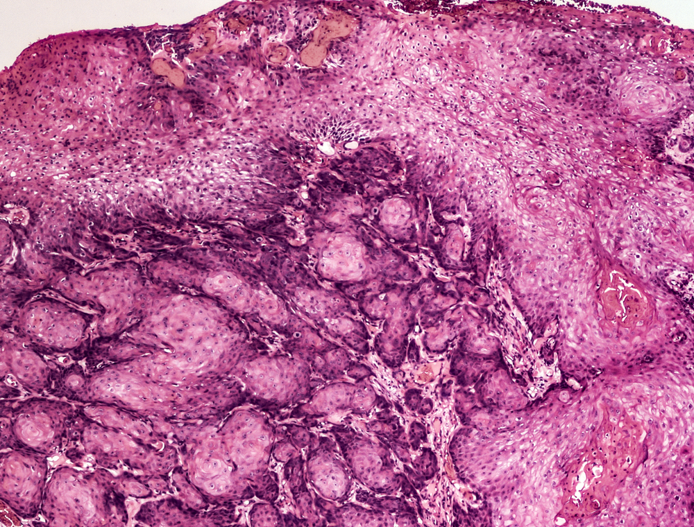 Karcinom penisa uzrokovan HP virusom, pod mikroskopom