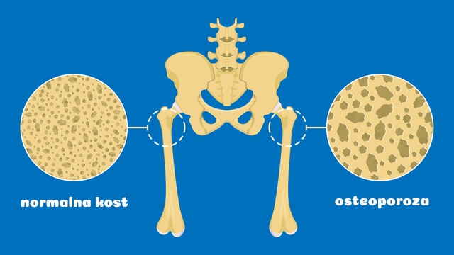 Ilustracija normalne kosti i kosti u osteporozi