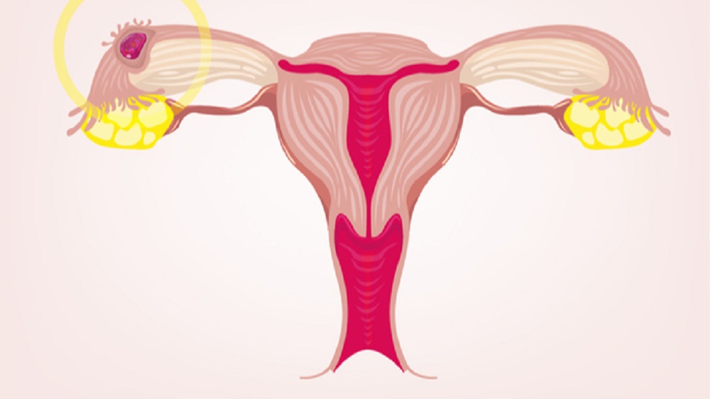Ilustracija pozicije jajasca pri vanmatericnoj trudnoci