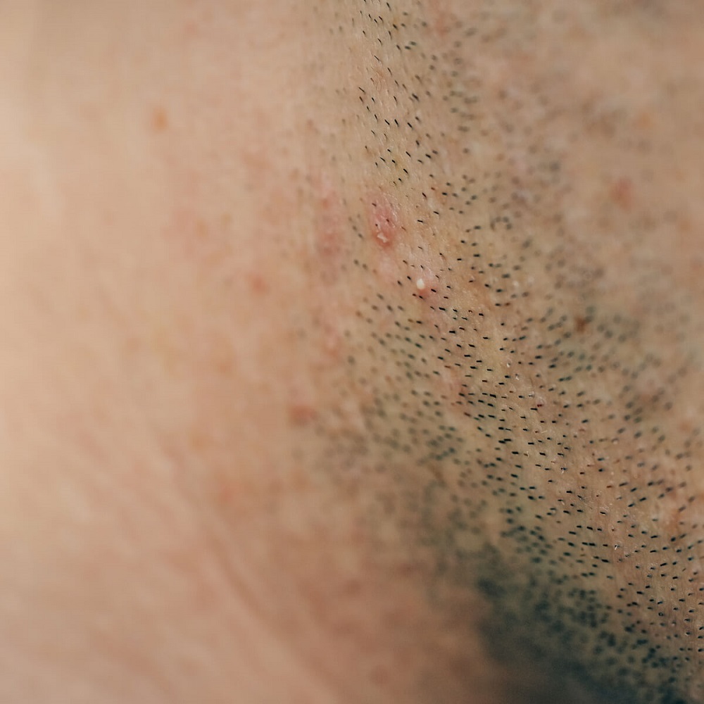 iritacije kože po brijanju
