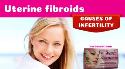 Uterine fibroids and Femisan A