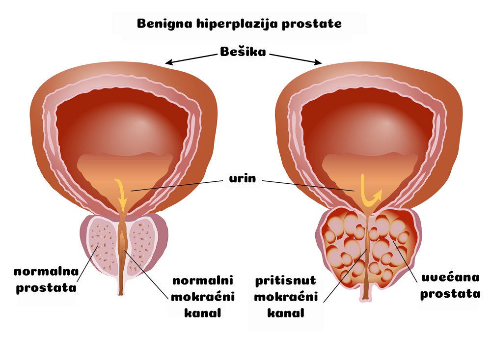 Normalna prostata i uvećanje prostate, ilustracija