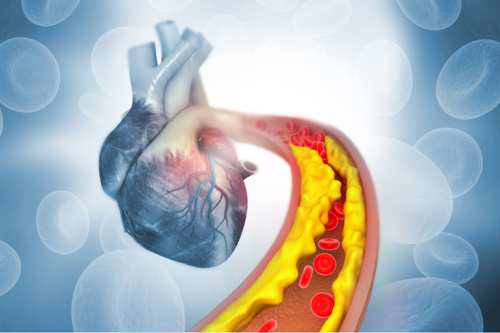 ateroskleroza izaziva infarkt