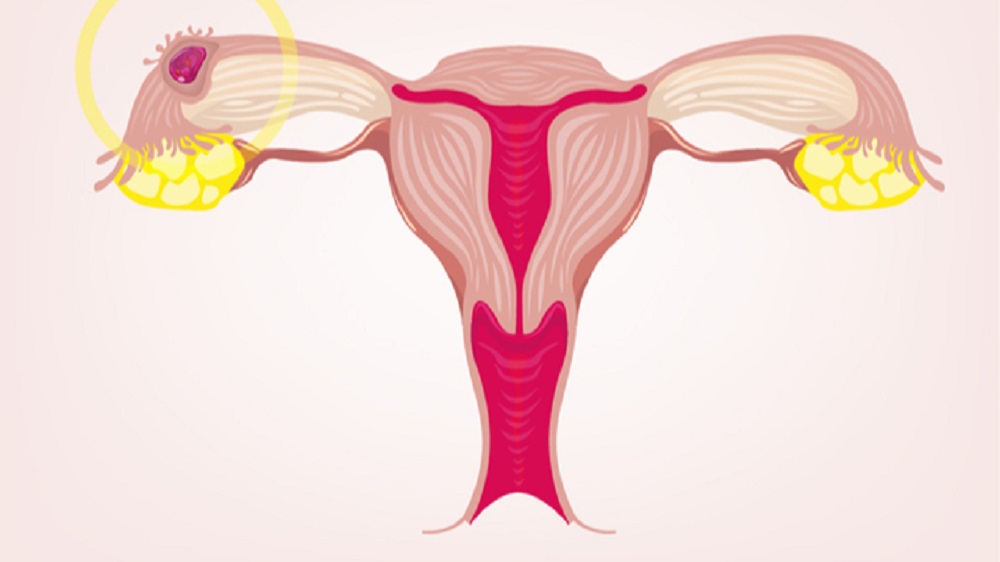 Ectopic pregnancy, illustration