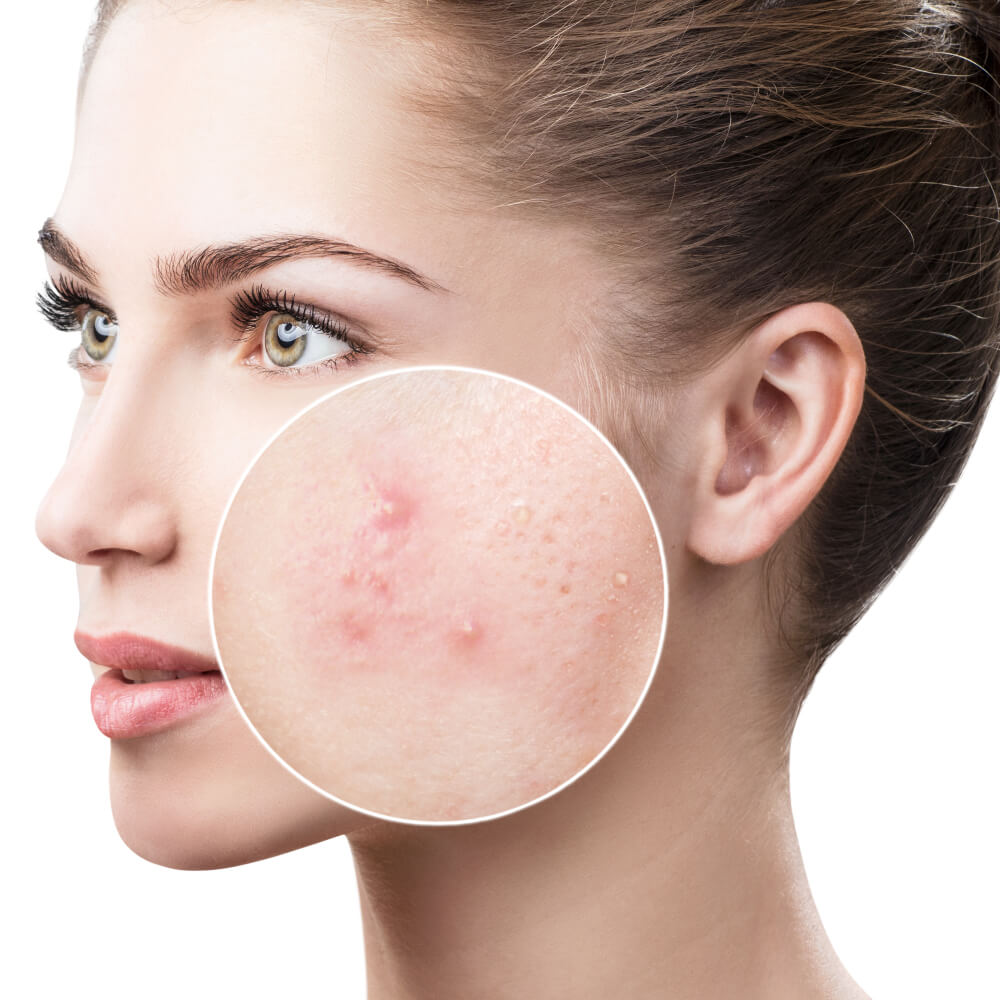 Magnified skin with hormonal acne