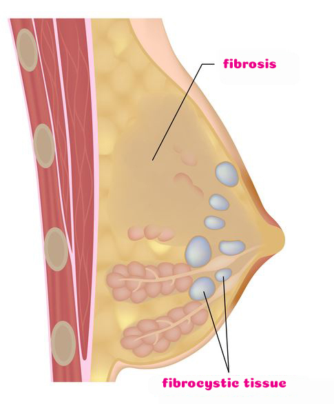 Breast cysts, fibrocystic tissue