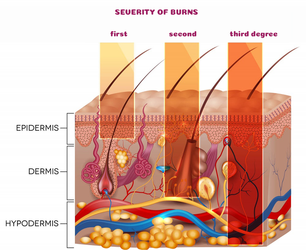 A chart with degrees of burns