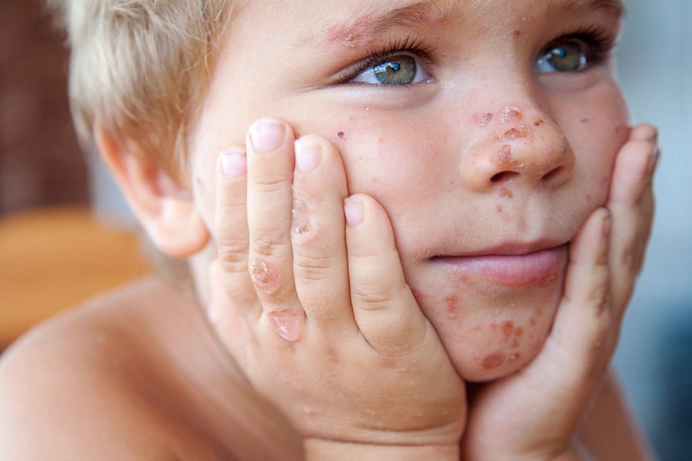 A child with psoriasis on face and hands