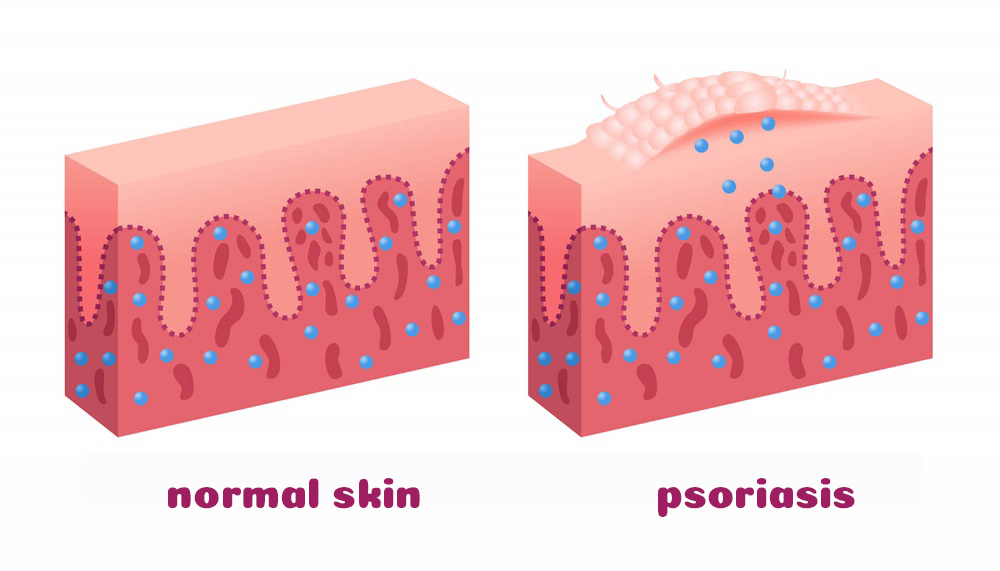 normal skin vs. psoriasis
