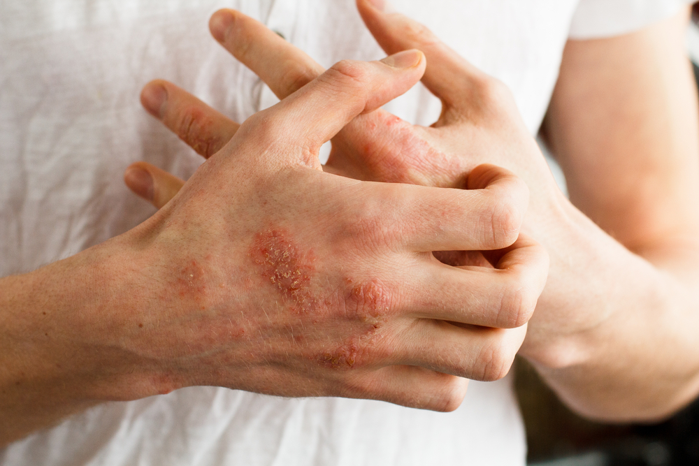 Hands affected with eczema