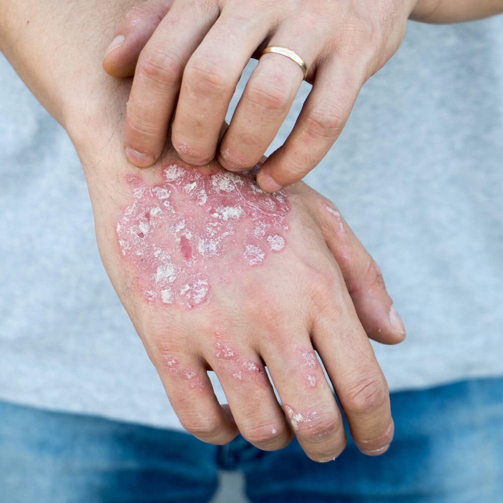 hands affected with psoriasis