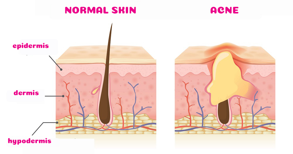 normal skin vs. acne