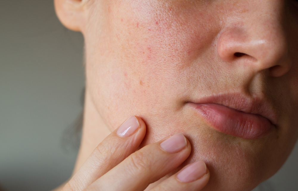 Osetljiva koža lica sa vidljivim iritacijama