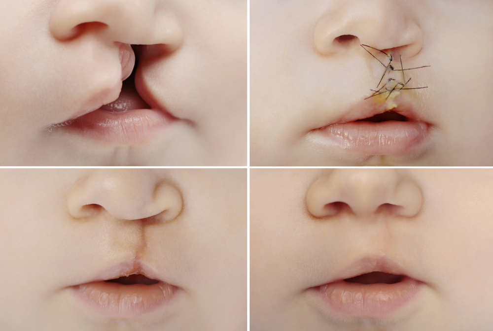 rascep usne - četiri faze: pre, posle operacije i nakon oporavka