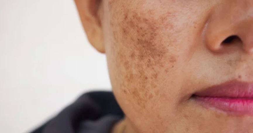 A woman with hyperpigmentation on her cheek