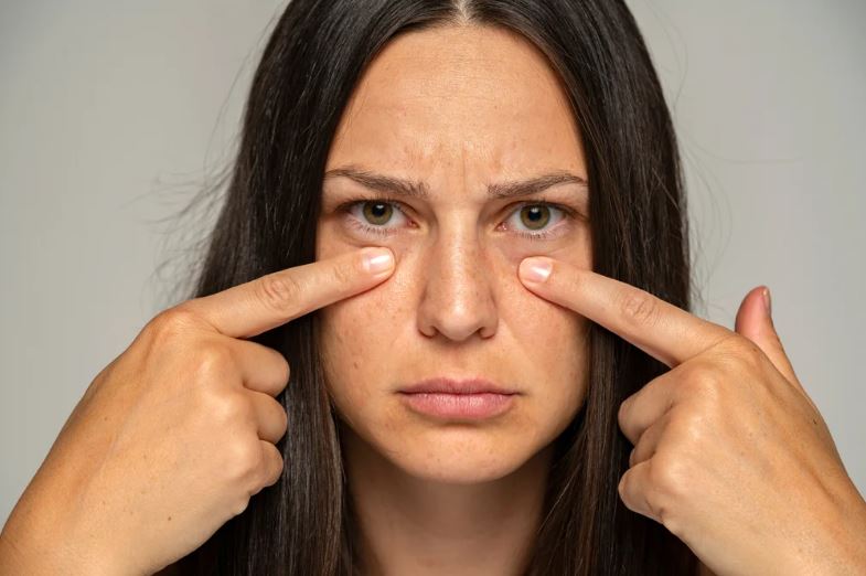 A woman complaining about her undereye circles