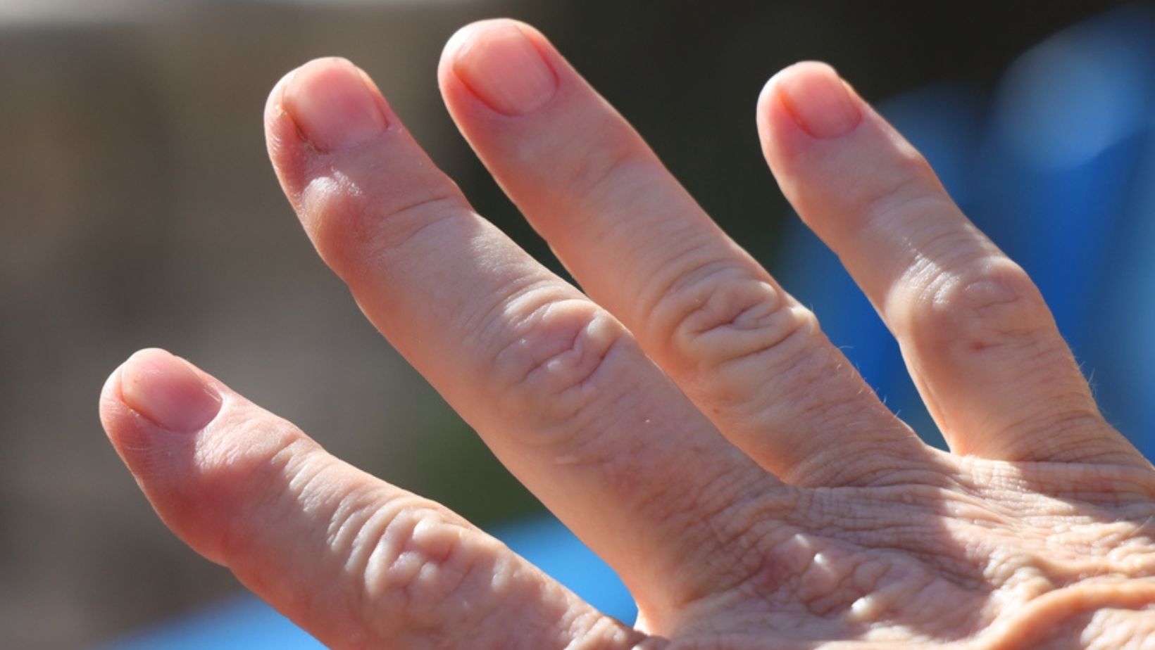 Heberdenovi čvorići na prstima, fotografija