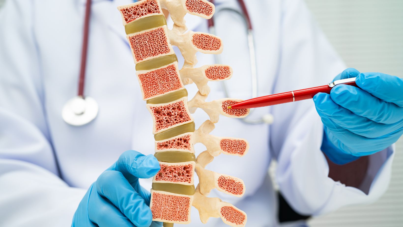 Doktor na modelu kičme pokazuje osteoporotične pršljenove