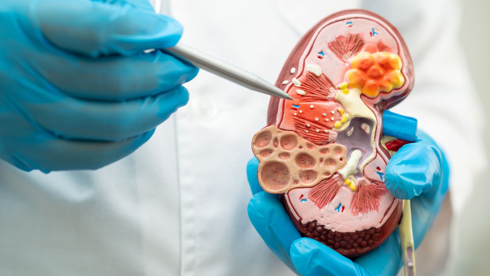 doktor pokazuje kako nastaje kamen na modelu bubrega